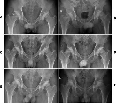 An all-arthroscopic light bulb technique to treat osteonecrosis of the femoral head through outside-in fashion without distraction: A case report